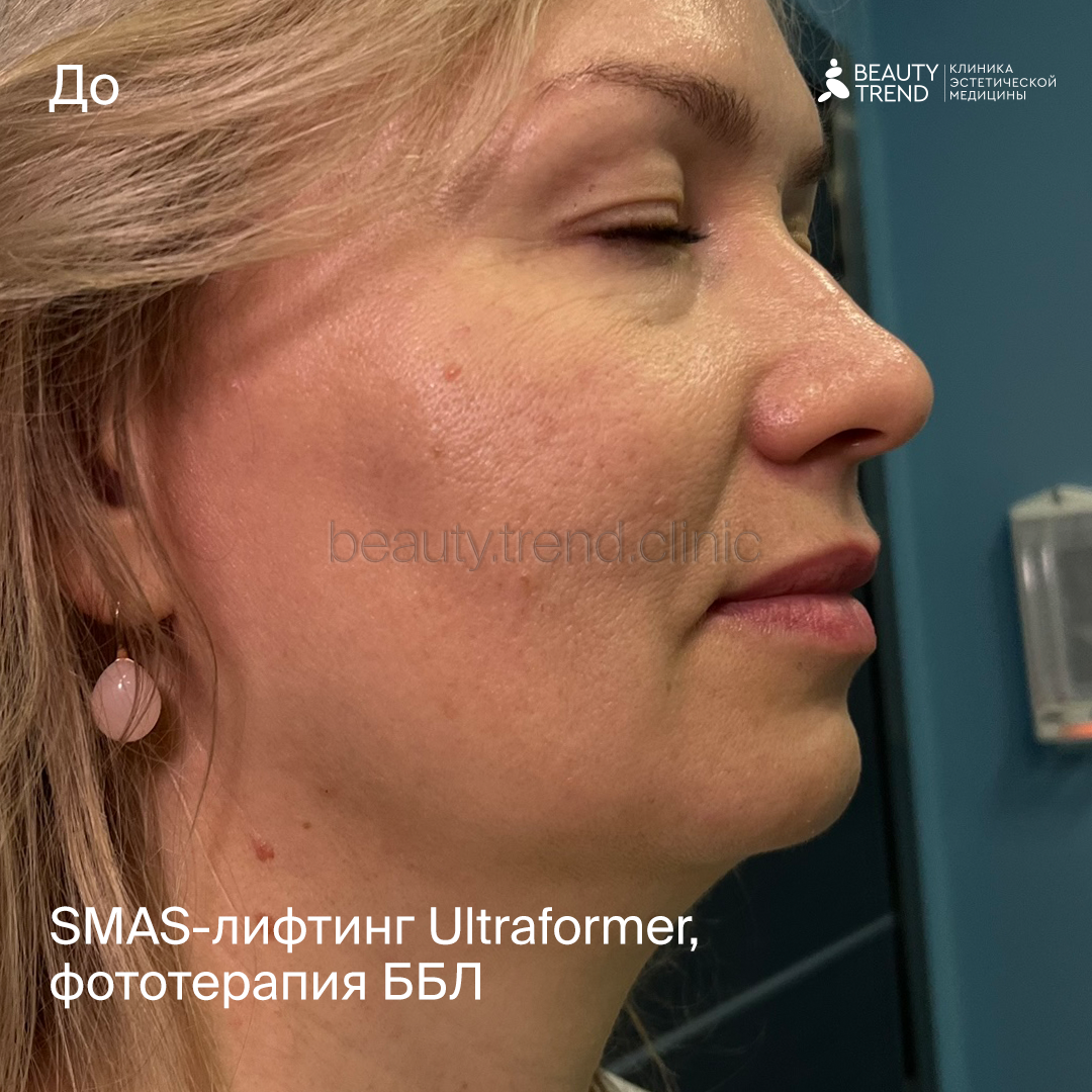 Ultraformer MPT, фототерапия BBL - до 1